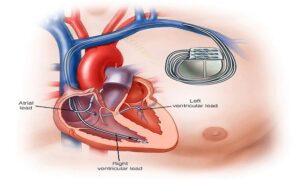 pacemaker implant ppi