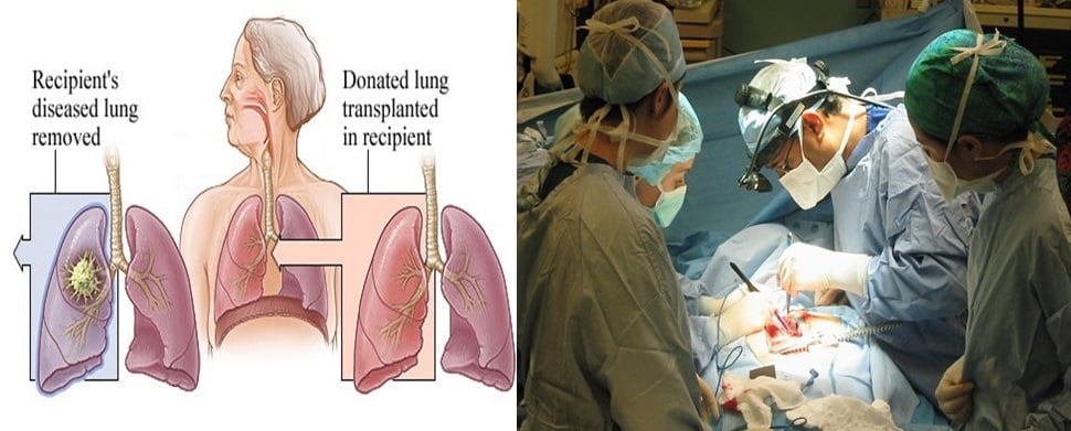 Lung Transplant In India - Yashfiin Medical Tourism