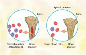 Treatment of Aplastic Anemia in Children