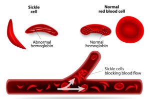 Treatment-of-Sickle-Cell-Anemia